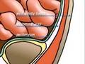 PreOp® Patient Education Hernia Repair - Inguinal (Open) I