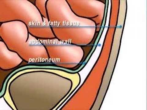 how to repair abdominal fascia