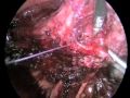 The importance of laparoscopic suturing in dealing with laparoscopic complications