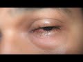 Marijuana Abuse Marijuana Abuse