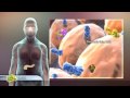 Type 2 Diabetes
