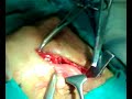 INGUINAL HERNIA operated by Surg. Hemant @ AFMC,Pune,India INGUINAL HERNIA operated by Surg. Hemant @ AFMC,Pune,India