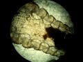 Head Lice