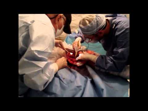 amputacion - BRIGADA MEDICA ECUATORIANA DE AYUDA EN HAITI JUNTO CON HARVARD AMERICAN HUMANITARIAN INITIATIVE Surgical team: Stuart Mackler, MD FACS, Oscar Ojeda MD Amputa...