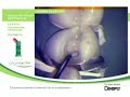 Ceram X duo: Restauraci�n de posteriores Dr. Dietschi