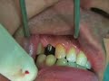 One tooth in a day One tooth in a day