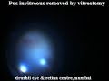 Endophthalmitis Post Complicated Cataract Surgery