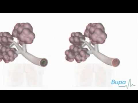 how to cure klebsiella pneumoniae