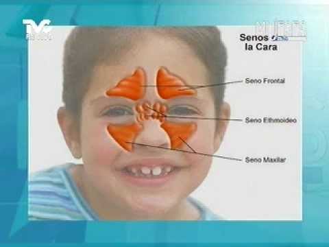 VER VIDEO OPERACION SINUSITIS ver video operacion sinusitis: