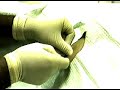 lat cervical epidural