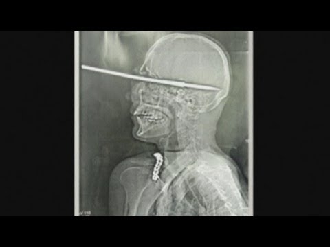X-ray pics: Man shoots himself in the face with a harpoon in Brazil...and survives!