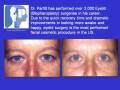 videos de Eyelid Lift Blepharoplasty by Dr. Richard Parfitt