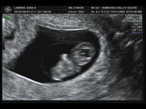 Ultrasound 8 weeks 6 ultrasound 8 weeks. Ultrasound 8 weeks 6
