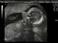 Ultrasound