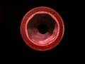 Atherosclerotic Plaque Accumulation
