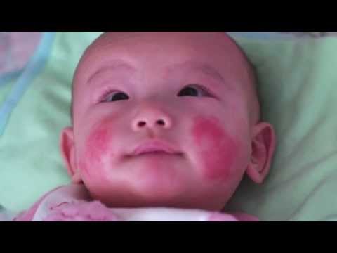 how to soothe baby eczema