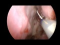 Balloon Sinuplasty of Sphenoid Sinus Balloon Sinuplasty of Sphenoid Sinus