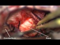 Acoustic Neuroma-Neurinoma do Acústico