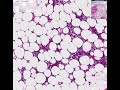 Histopathology Bone--Multiple myeloma