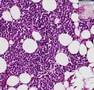 Histopathology Bone--Multiple myeloma