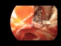 Leak of Cerebrospinal Fluid through Left Supraorbital Ethmoid Sinus and Repair of Defect Leak of Cerebrospinal Fluid through Left Supraorbital Ethmoid Sinus and Repair of Defect