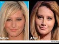 Ashley Tisdale Nose Job And Plastic Surgery Pics! Read Descr