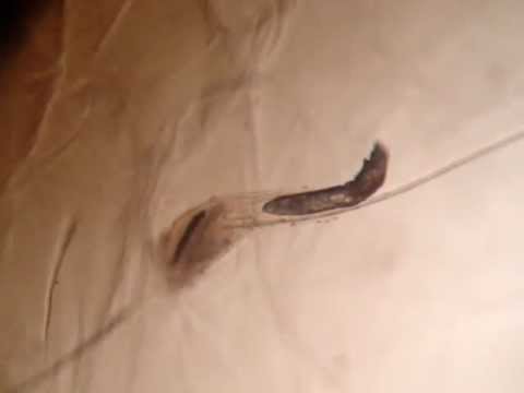 how to treat d. folliculorum