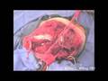 Osteosarcoma Resection Of The Humerus Proximal End - Part 5/6 Osteosarcoma Resection Of The Humerus Proximal End - Part 5/6