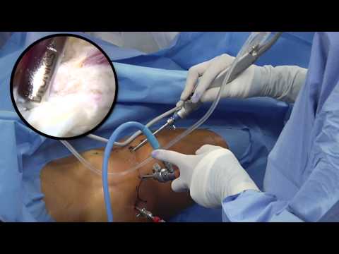 Hip Arthroscopy From Fundamentals to FAI and Labral Repair by JW Thomas Byrd MD