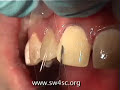 Fluorosis