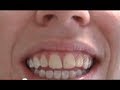 Fluorosis