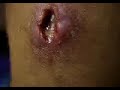 Spider Bite Turned Staph Infection