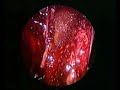 Repair Of Umbilical Hernia, A Difficult Case Repair Of Umbilical Hernia, A Difficult Case