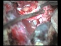 Petroclival meningioma - Right transpetrosal approach