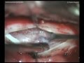 Thoracic dural AVM - Posterior approach