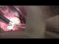 Coblation Tonsillectomy