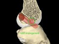 Notch impingement Notch impingement
