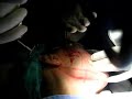 Sciton Profractional Facial 01