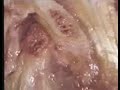 Pathology: Anterior DDR