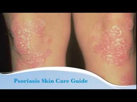 how to care psoriasis