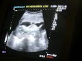 Echographie - 20060511