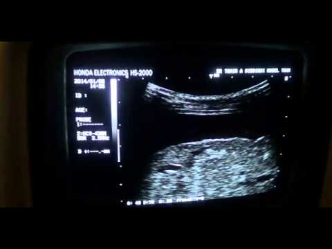 how to treat obstructive jaundice