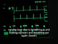 breath induced speeding up / slowing down of heart rhythm breath induced speeding up / slowing down of heart rhythm