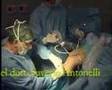 Ricostruzione del LCA con legamento artificiale LARS