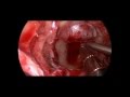 Endonasal Endoscopic Pituitary Adenoma Surgery