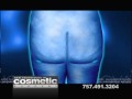 Dr. Galumbeck shows laser liposuction of the hips & thighs
