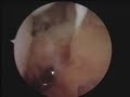Rheumatoid arthritis synovectomy ??????????????? ????????? ?????? ????????? Rheumatoid arthritis synovectomy ??????????????? ????????? ?????? ?????????
