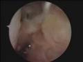Elbow Capsule Incision In Rheumatoid Arthitis
