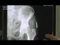arthritus pain, natural healing therapies,treatments for arthritis, find,