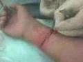 GETTING STICHES!!!!! not emo fucking idiots -.-